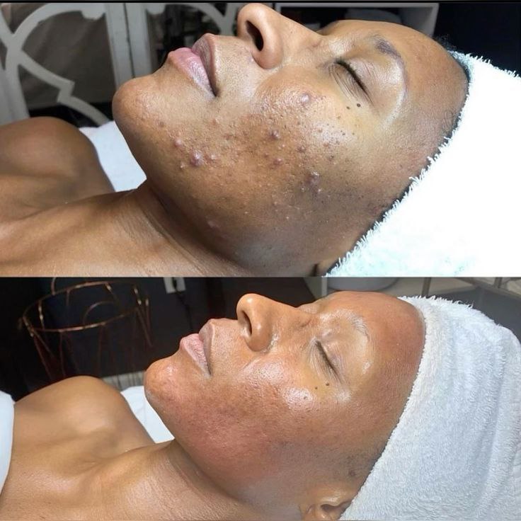 Masque facial LED USB thérapie de rajeunissement de la peau Anti-Acné